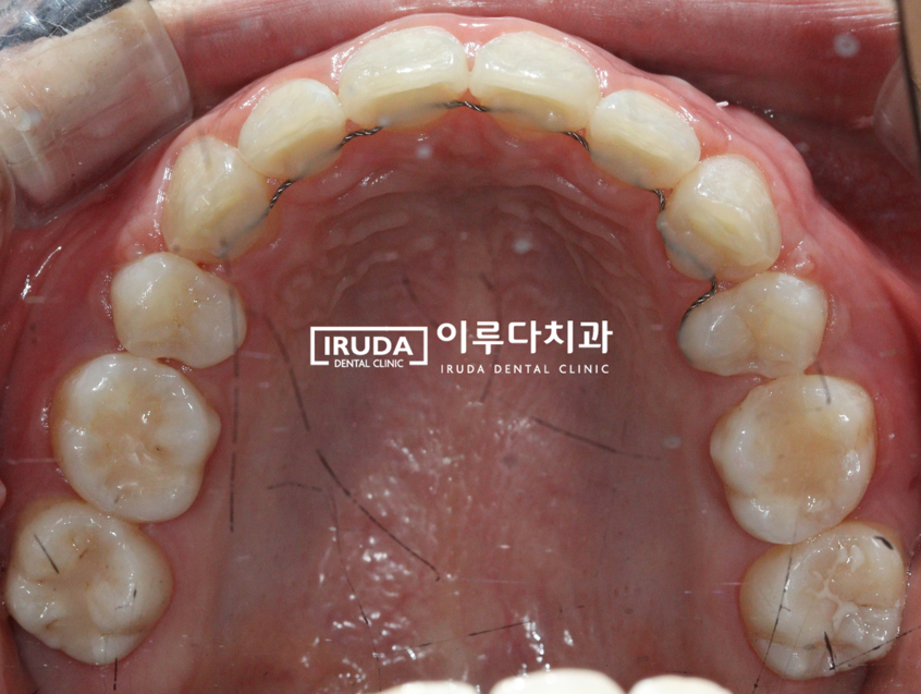 역곡역 교정치과 편악 발치교정 케이스 위쪽 치열 설측 유지장치 사진
