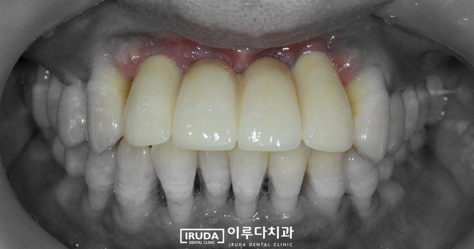 앞니 임플란트 식립 이후 잇몸선